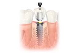 Dental Implant Nepal