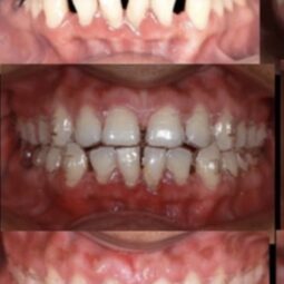 teeth aligners