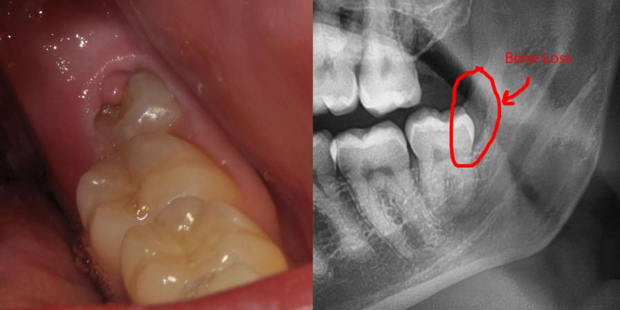 impacted-wisdom-teeth-removal-kathmandu