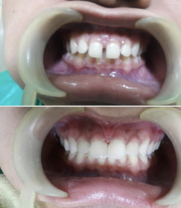 Teeth spaces/gaps closed using direct composite bonding