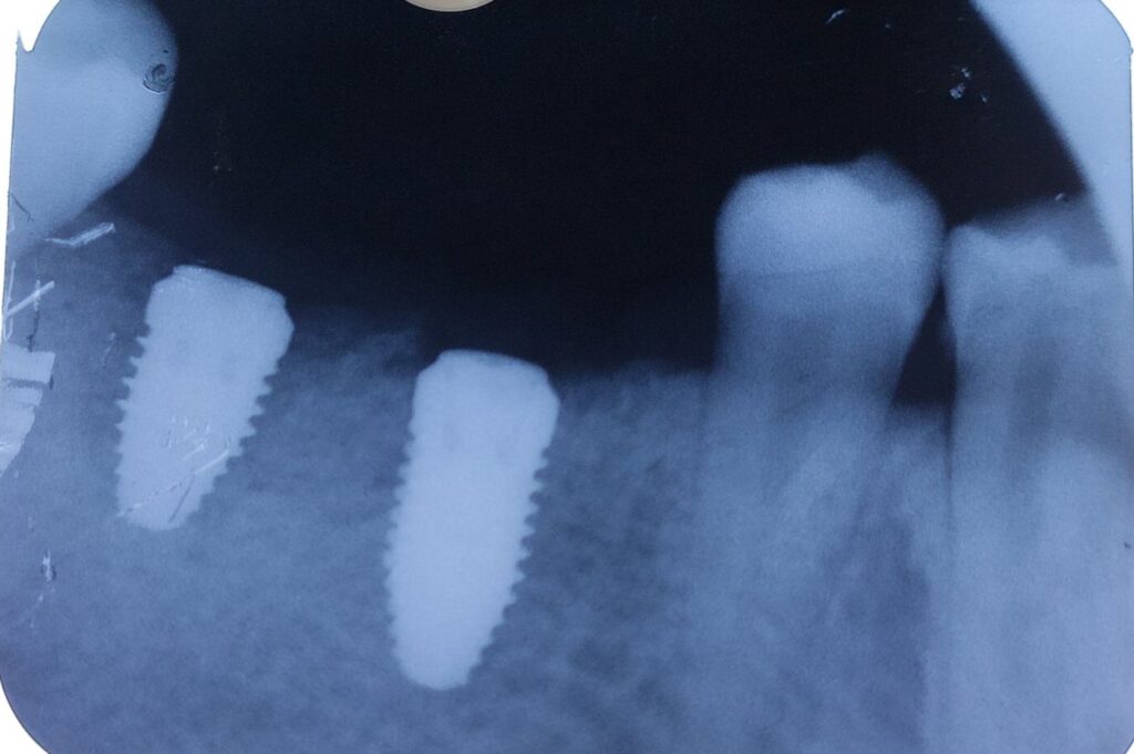 Dental Implant near me