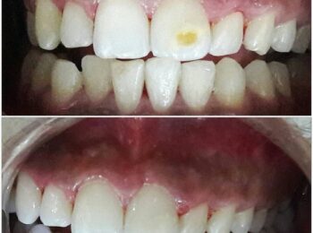 Yellow Spot in teeth